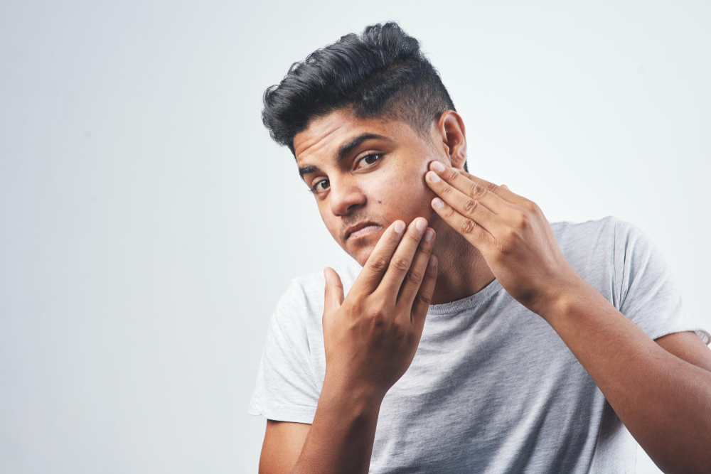 Is Acne Just a Teenage Problem?