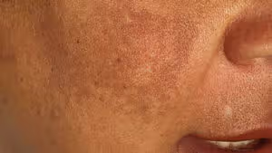 Hyperpigmentation Treatment
