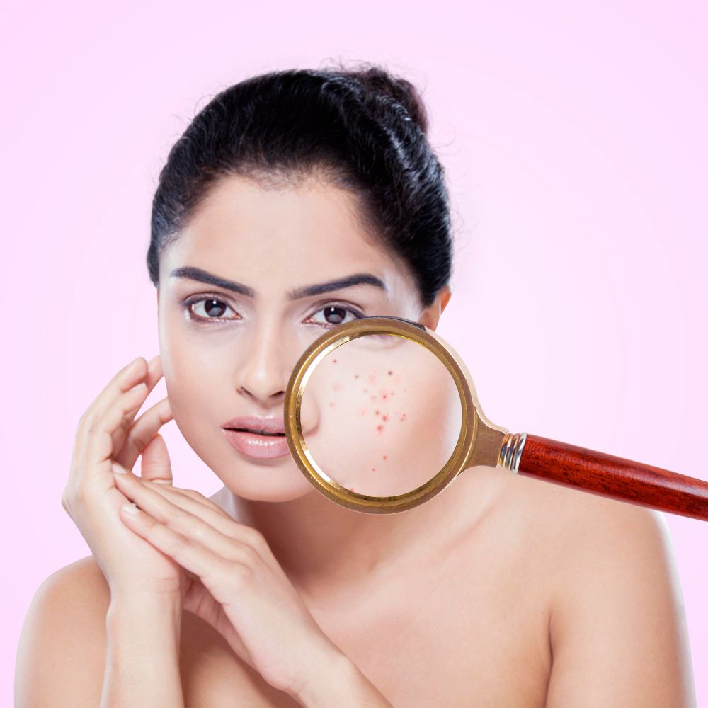 The Ultimate Guide to Treating Acne Successfully