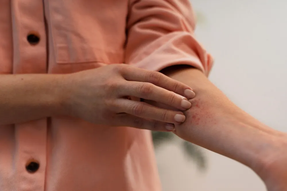Top Tips for Managing Eczema and Dry, Itchy Skin