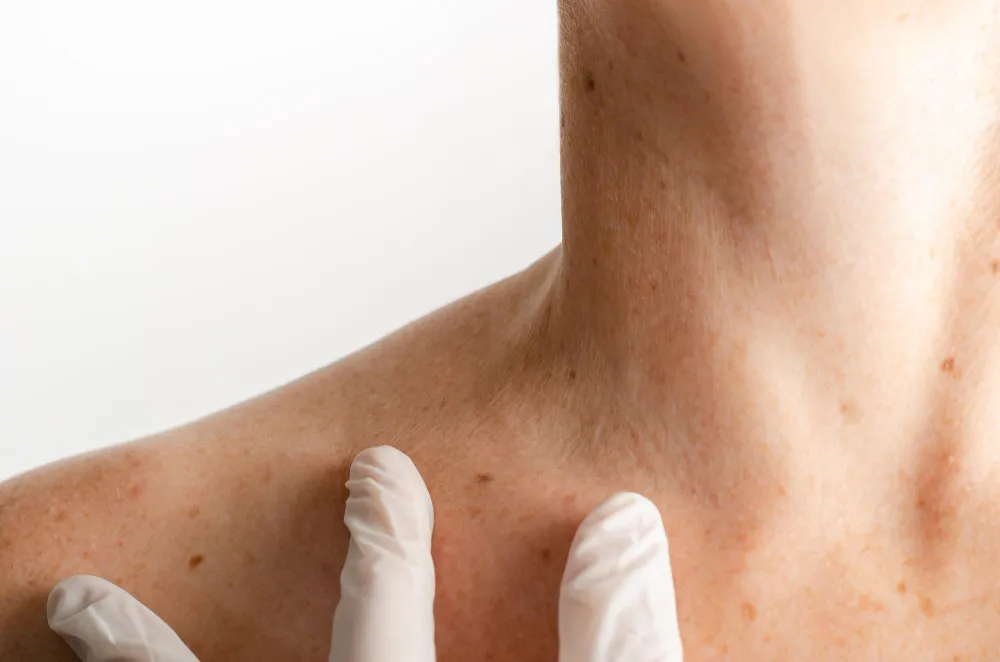 Neck Pigmentation Treatment