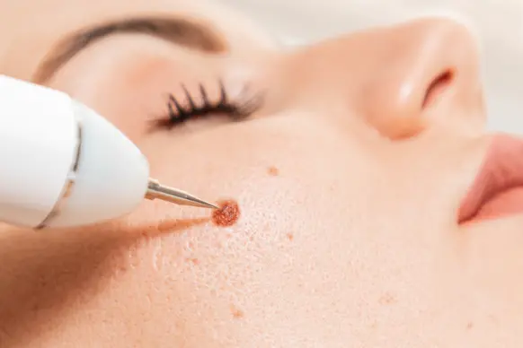 Moles and Warts Treatment