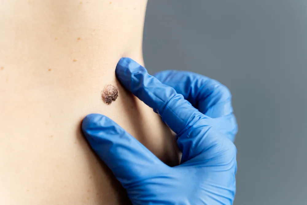 Skin Tag Removal