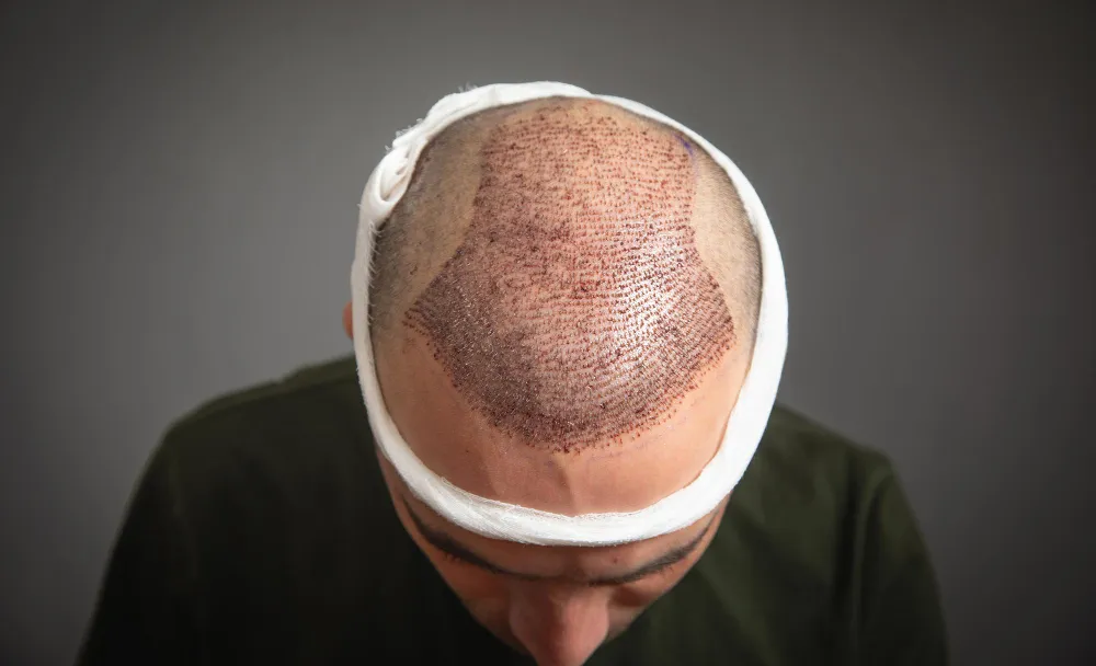 Hair Transplantation